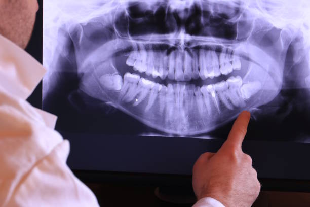 Best Emergency Wisdom Teeth Removal in Long Beach, CA